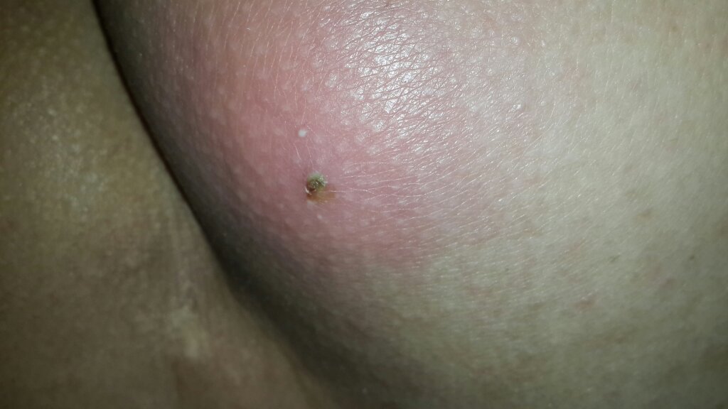 屁股上有个硬硬的包,不疼不痒