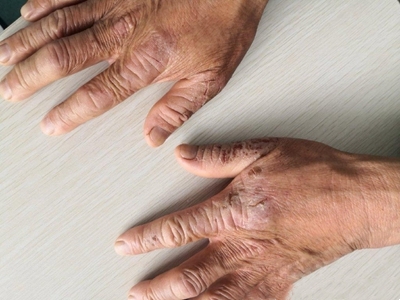 干燥综合症的症状表现