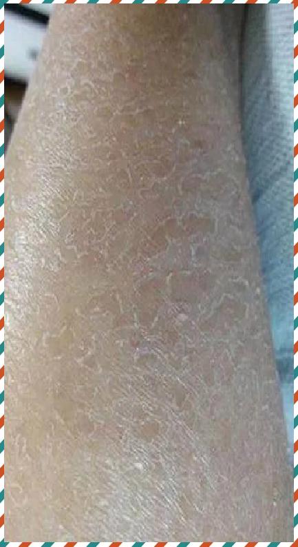 干燥综合症的症状表现