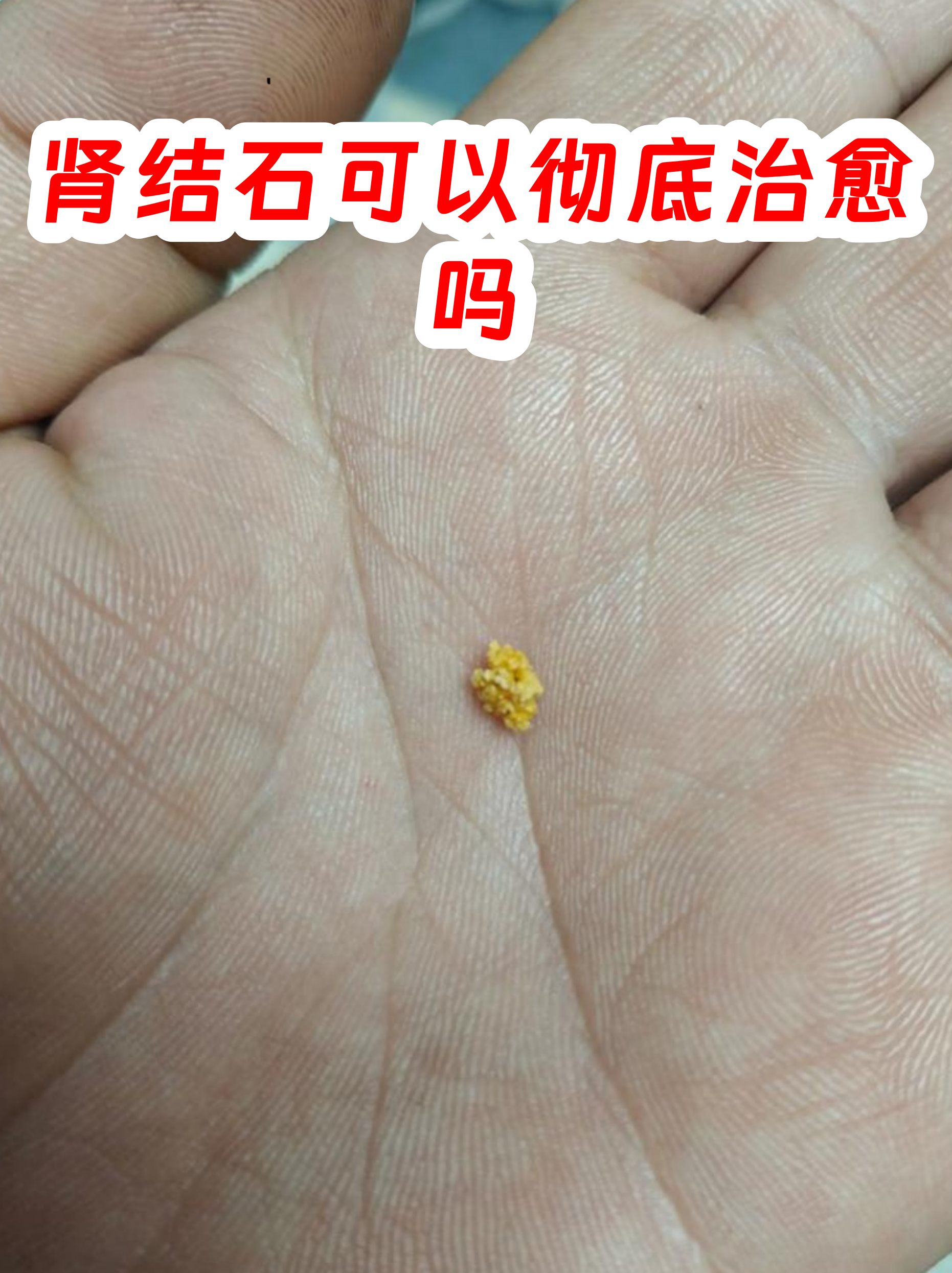 中药治疗肾结石方法有哪些