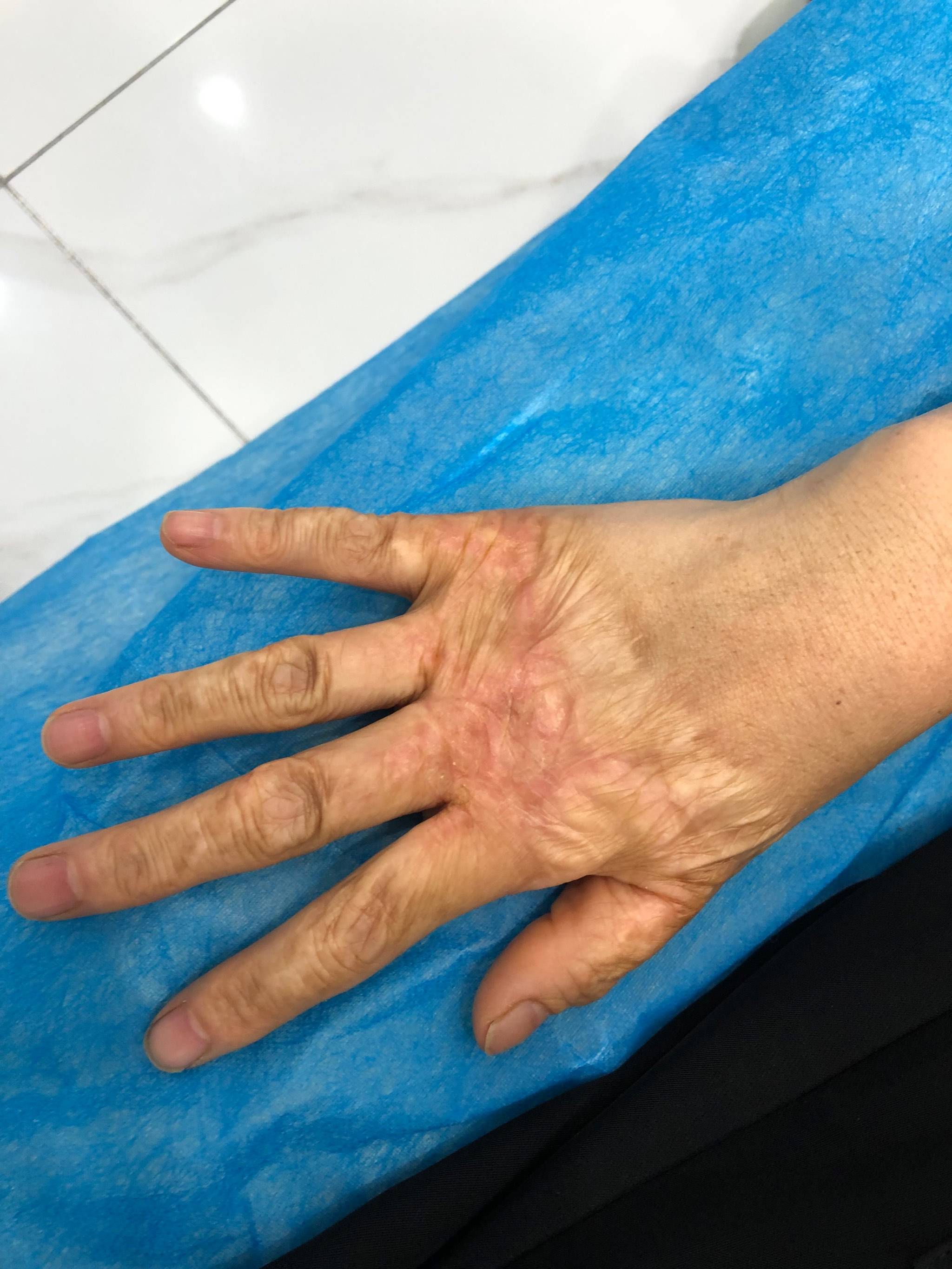 什么是疤痕体质?