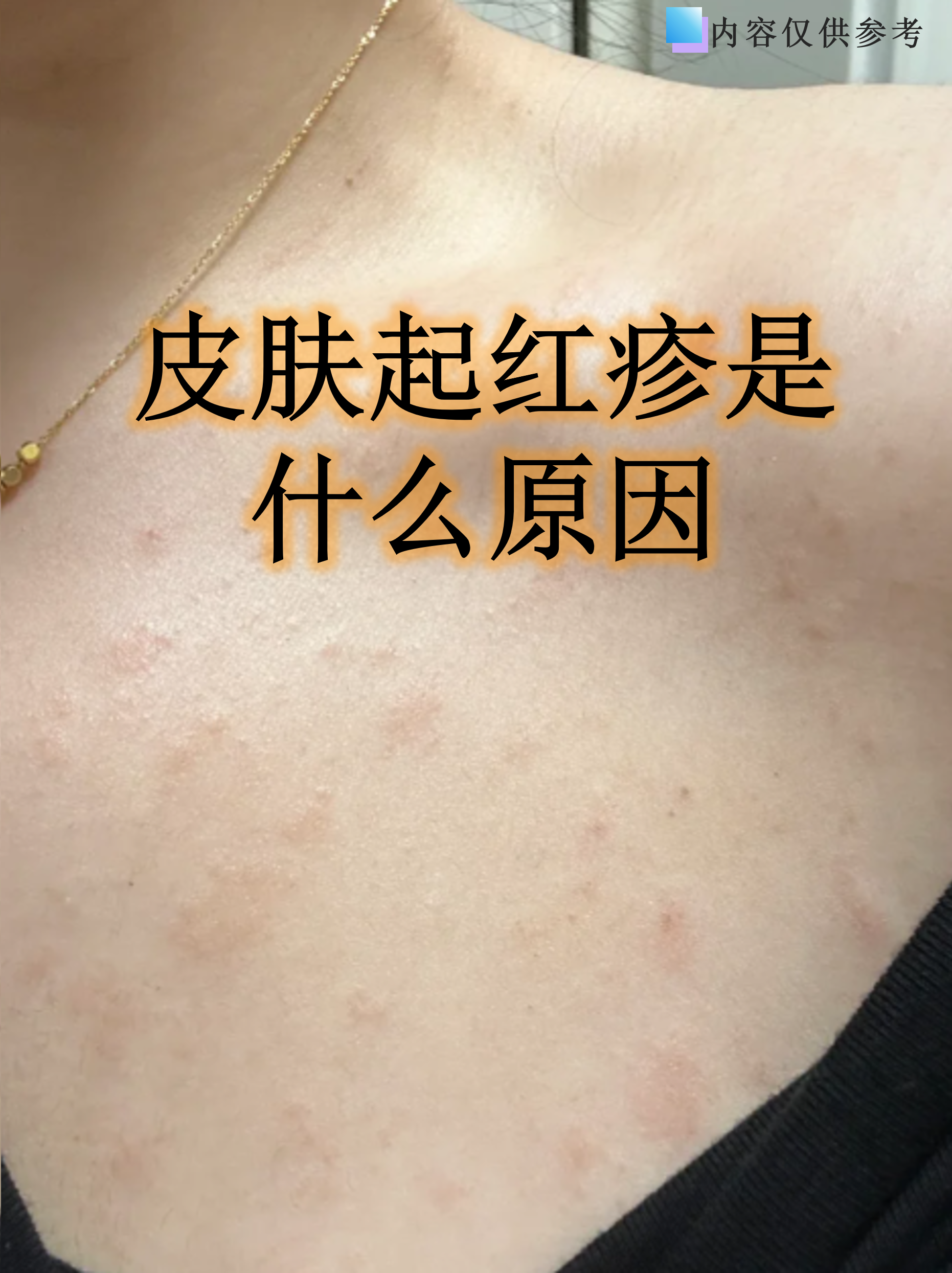 猩红热传染大人吗