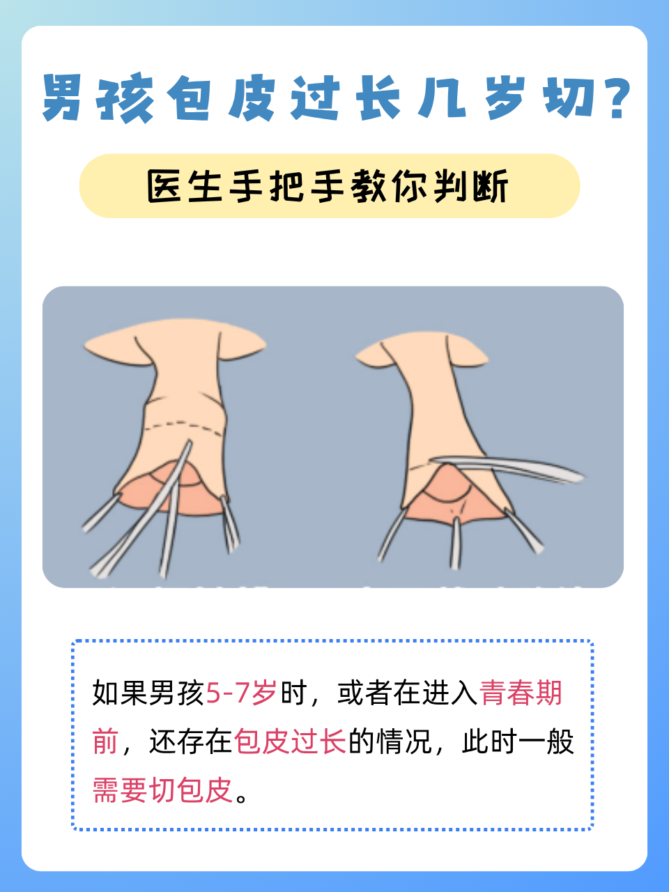 包皮过长会影响怀孕吗