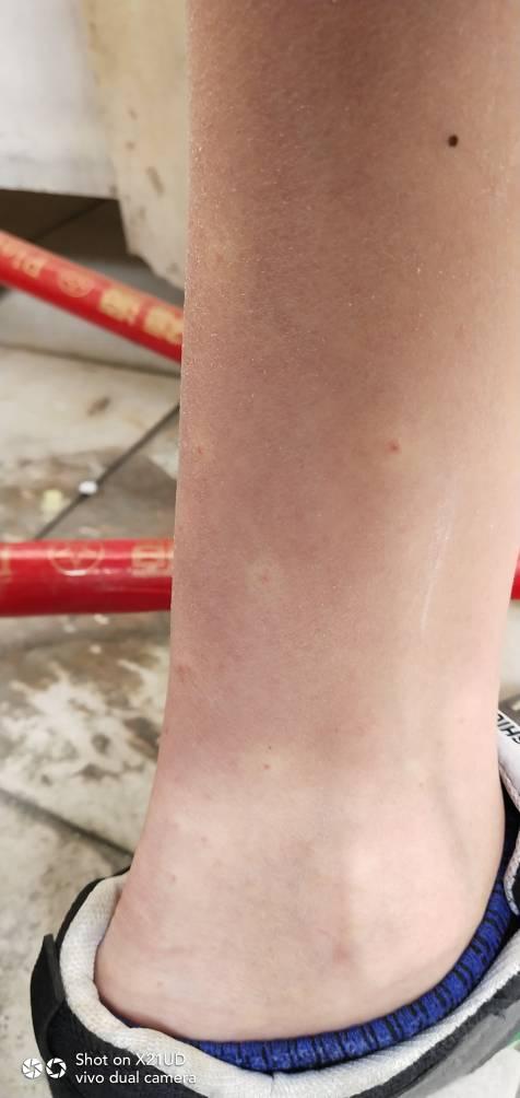 我小腿上这两天出现了像图片中的小红点