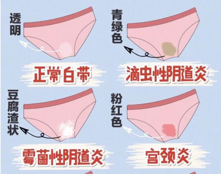 豆腐渣样分泌物是怎么回事