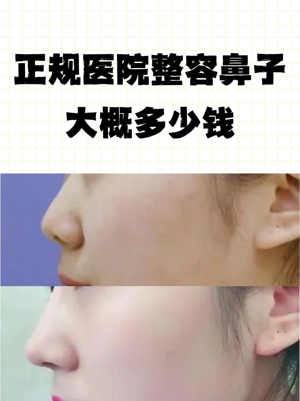 鼻子整形一般多少钱