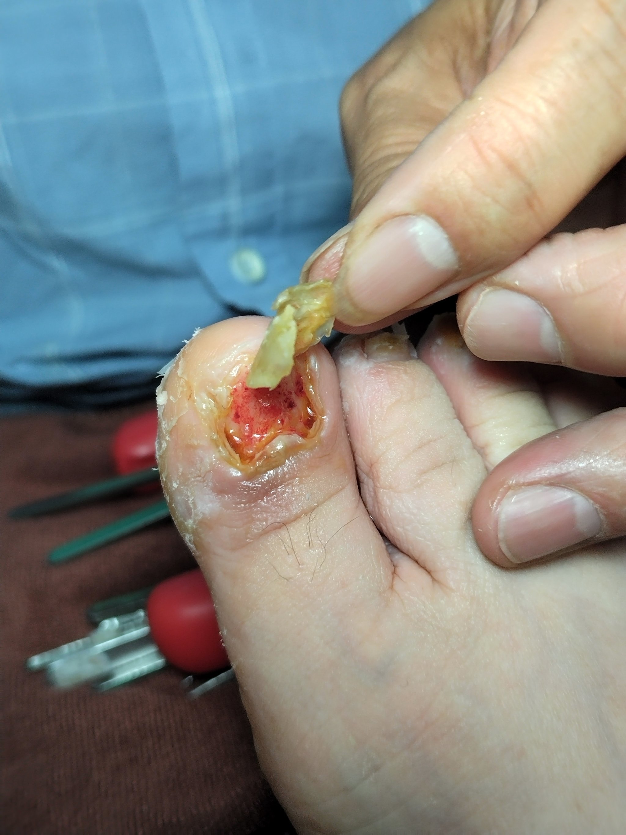 挂钩炎是什么症状