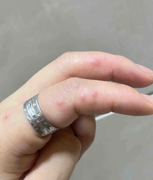 手上有长小水泡不痛不痒