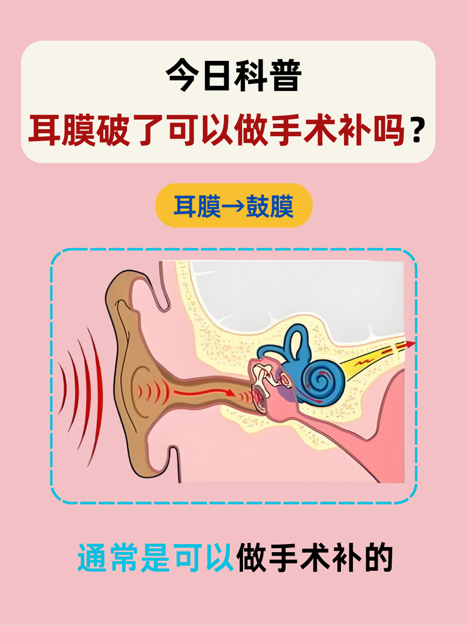 鼓膜穿孔后能自愈吗