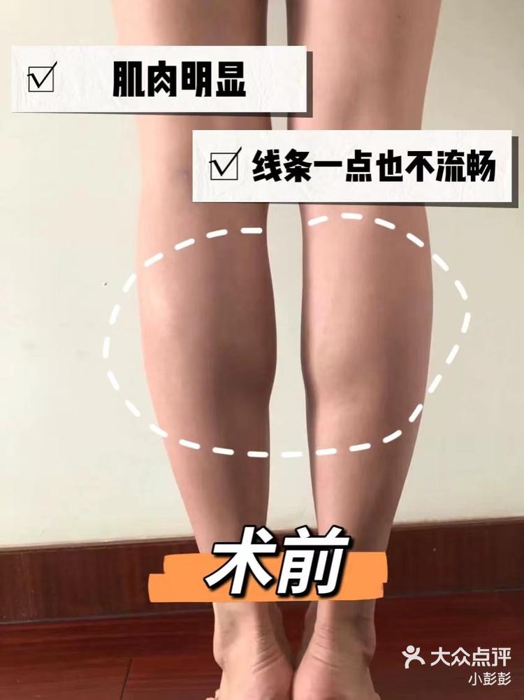 打瘦腿针多长时间见效