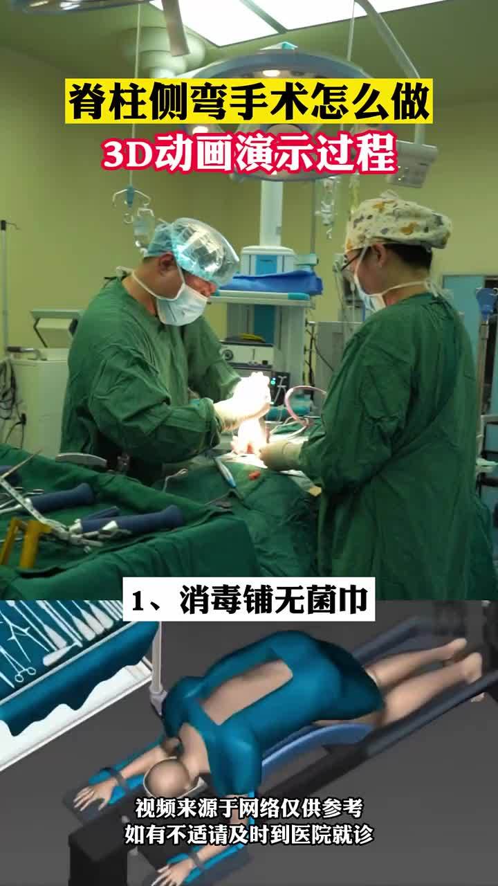 脊柱侧弯如何手术