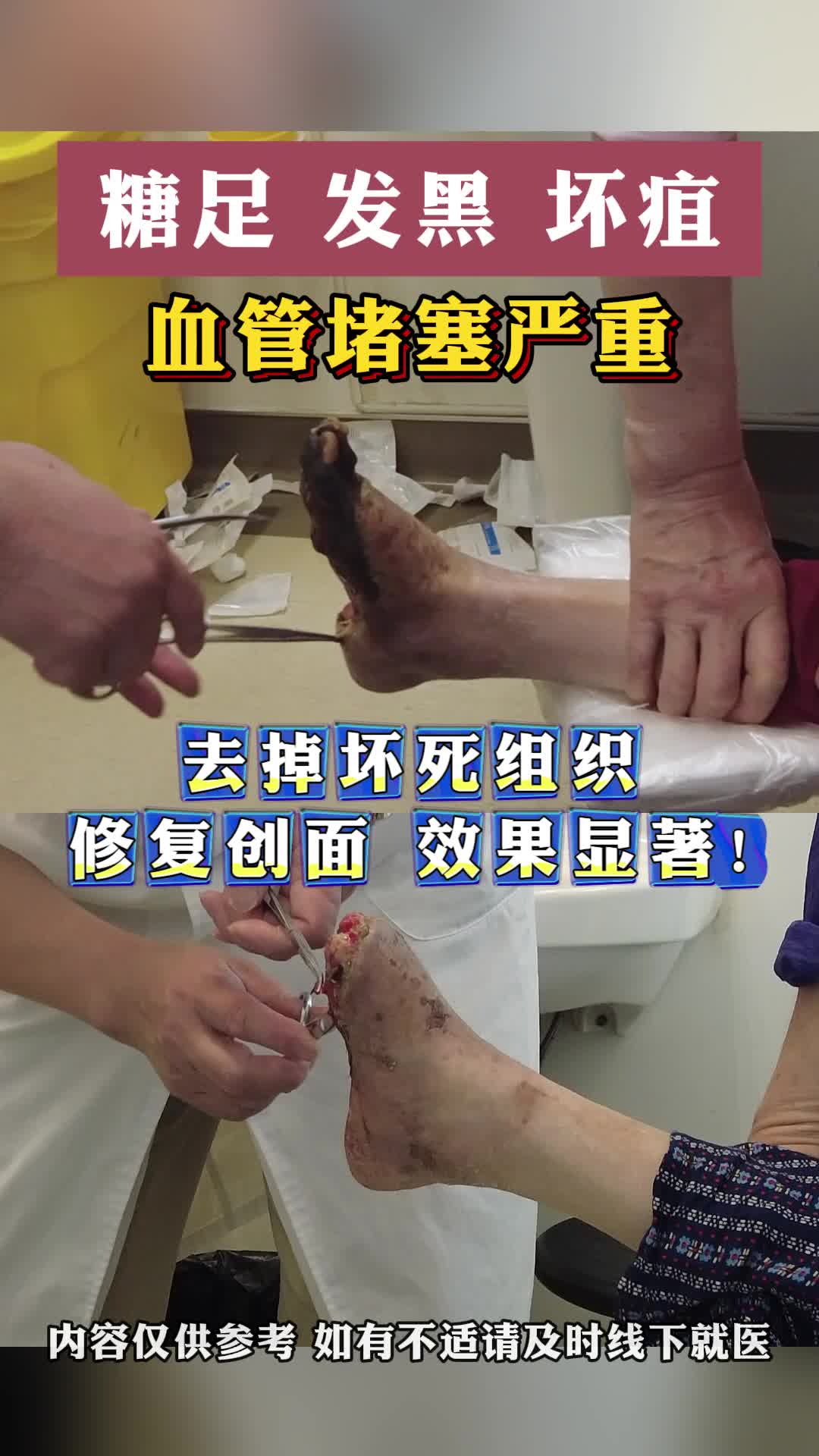 什么是糖尿病坏疽?