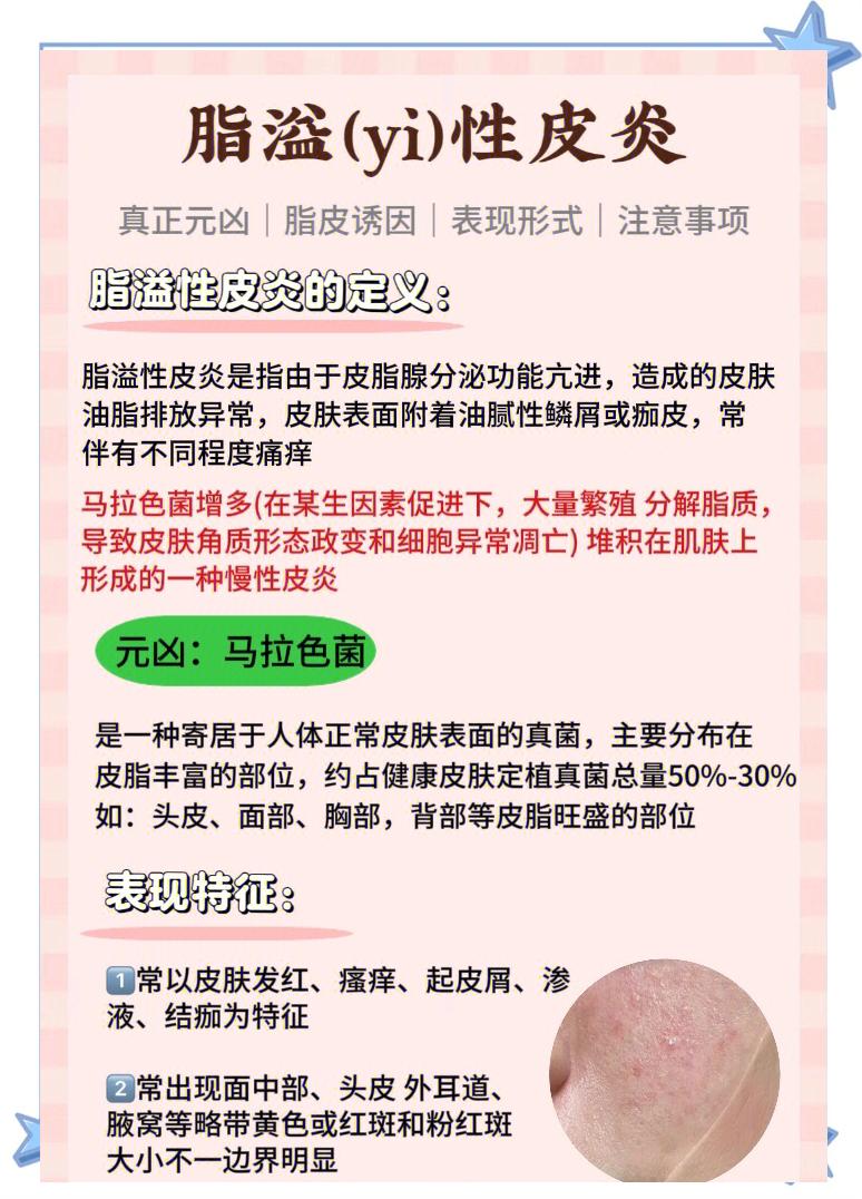 脂溢性皮炎是什么意思