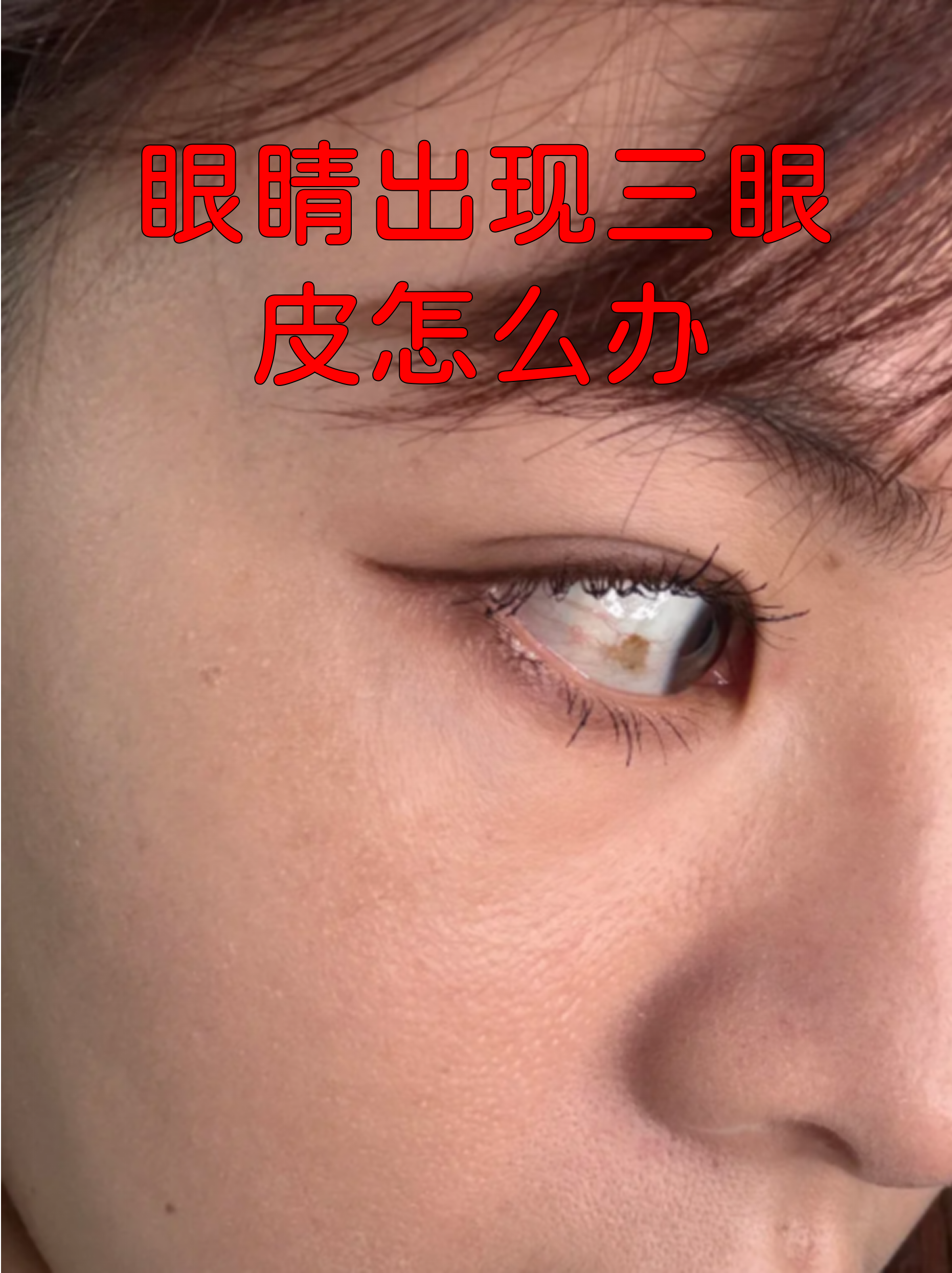 上眼皮脂肪厚怎么办,怎么样可以不用手术就消掉