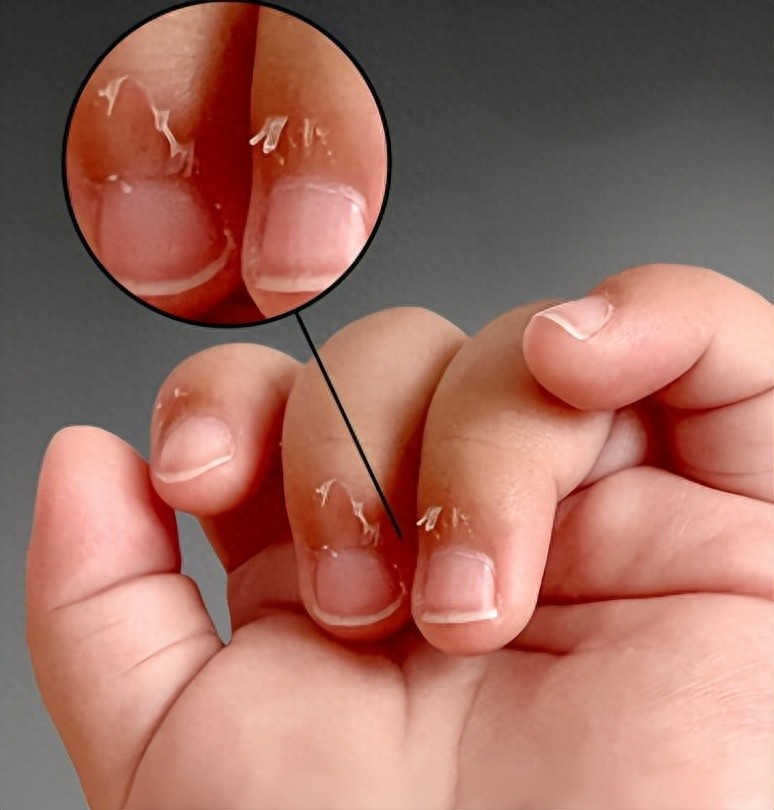 手上长倒刺怎么回事