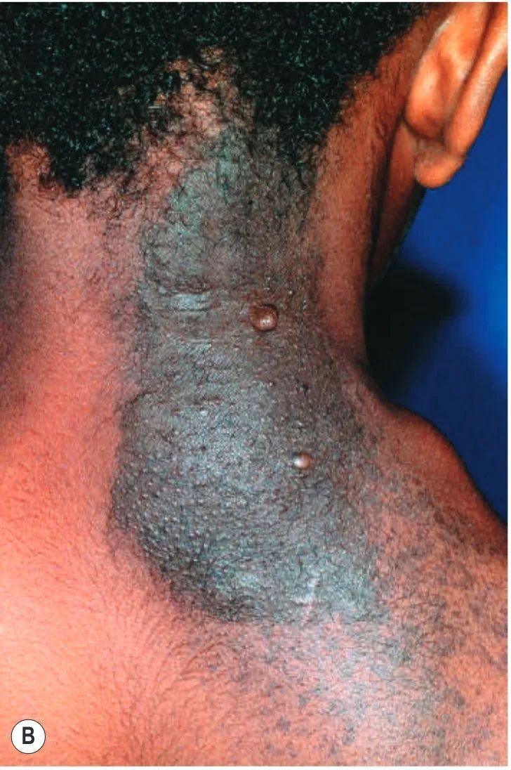 神经纤维瘤能要孩子