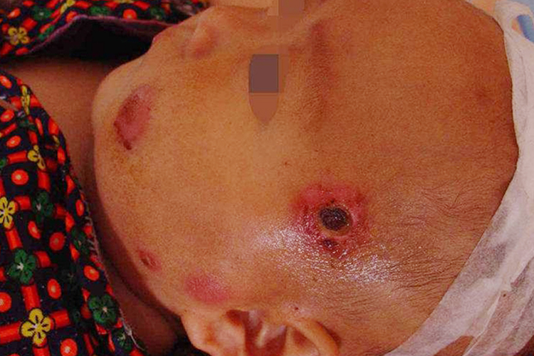 脸上长个大脓包怎么办