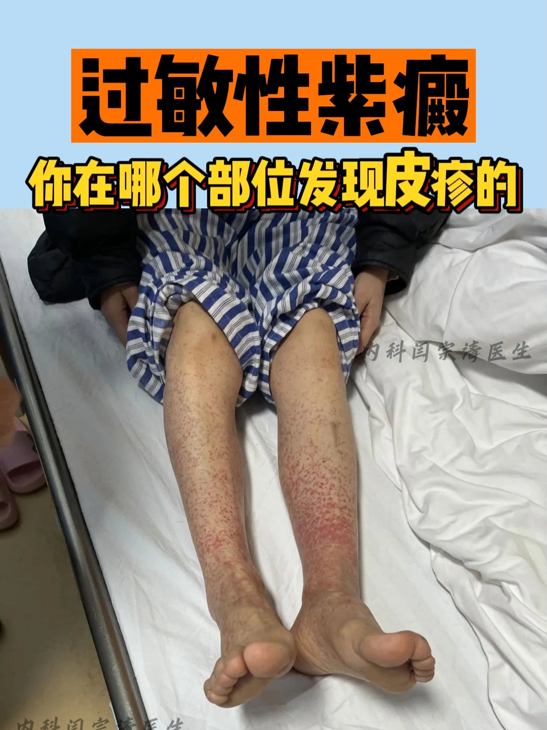 请问什么人会得过敏性紫癜?