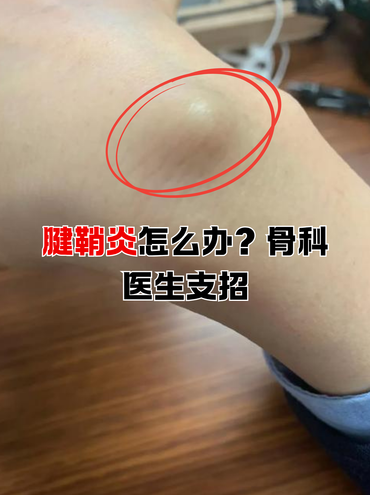 肌腱炎的症状有哪些