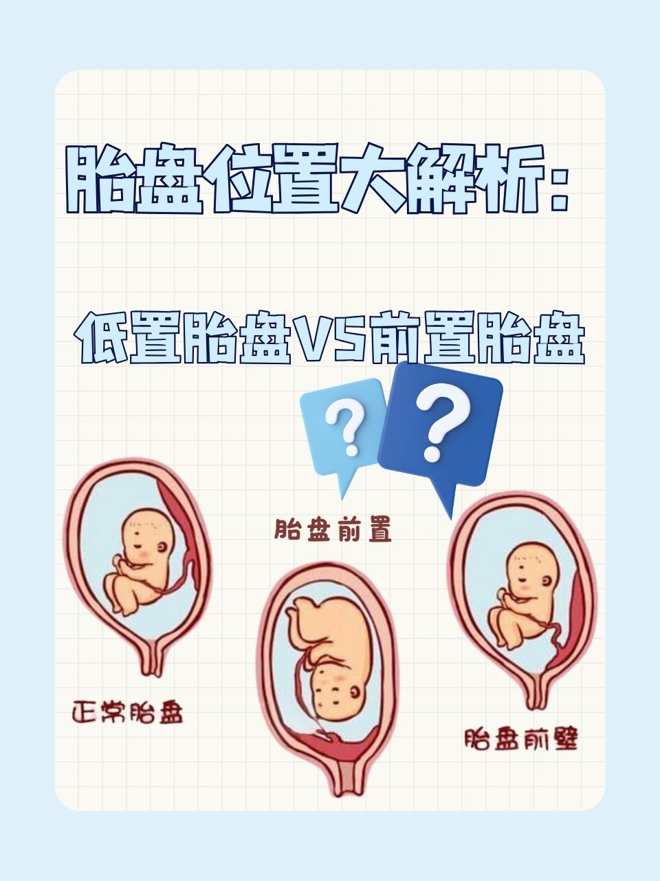 胎盘位于子宫前壁是什么意思