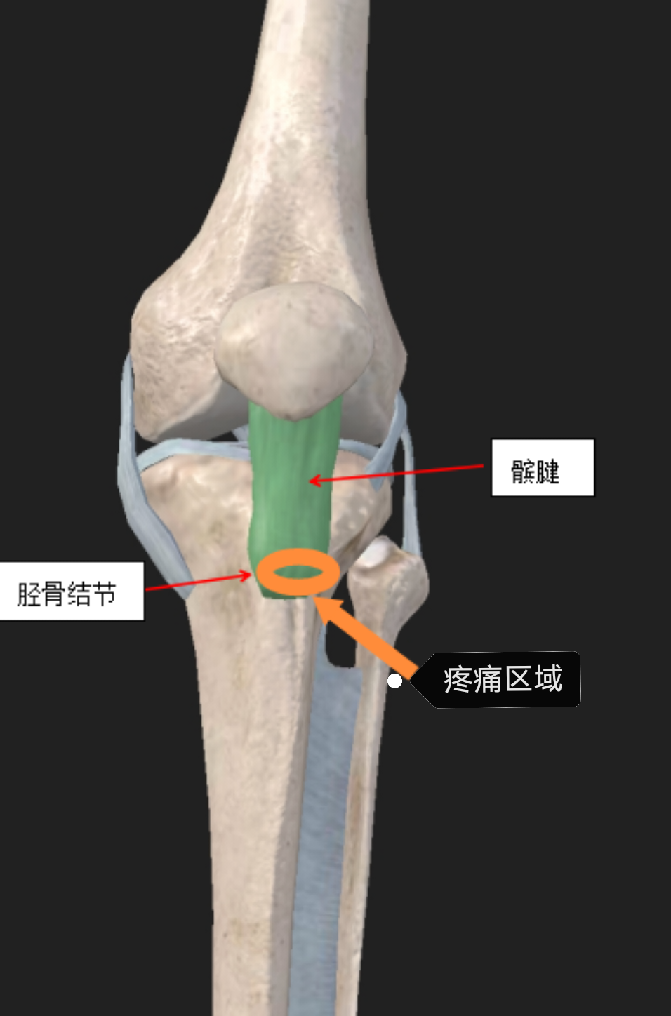 胫骨结节骨软骨炎有什么危害?