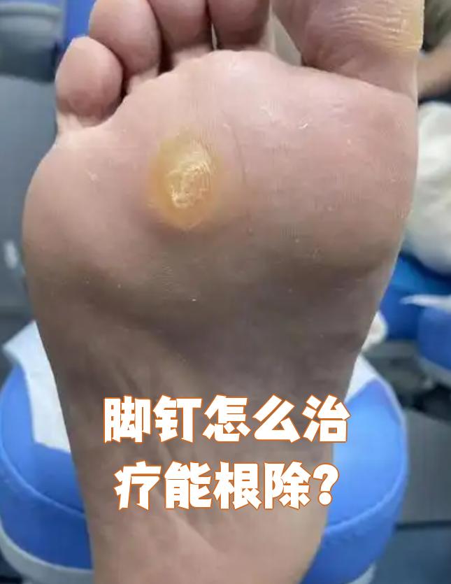 脚长鸡眼咋办