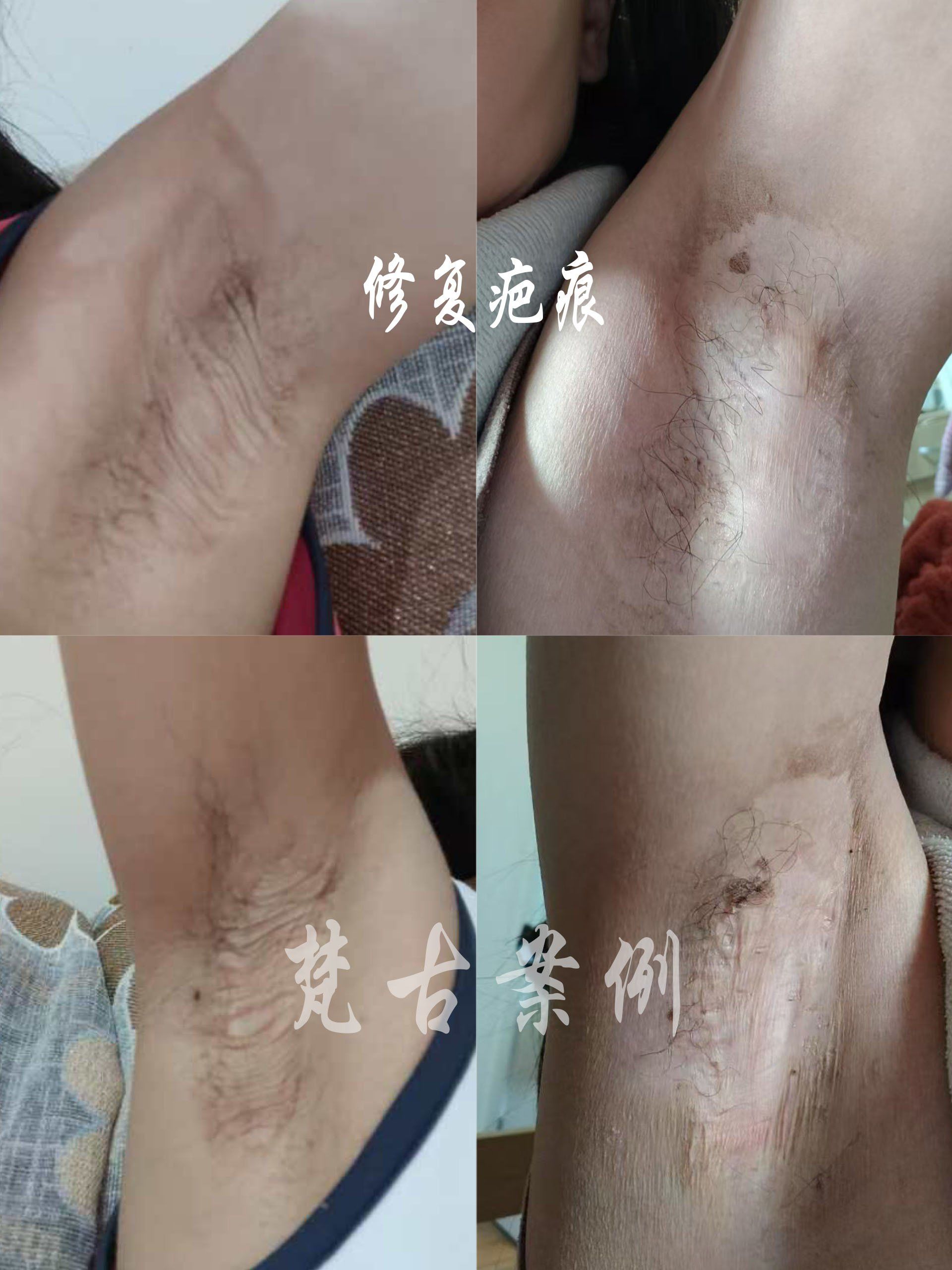 缝针的疤痕能去掉吗