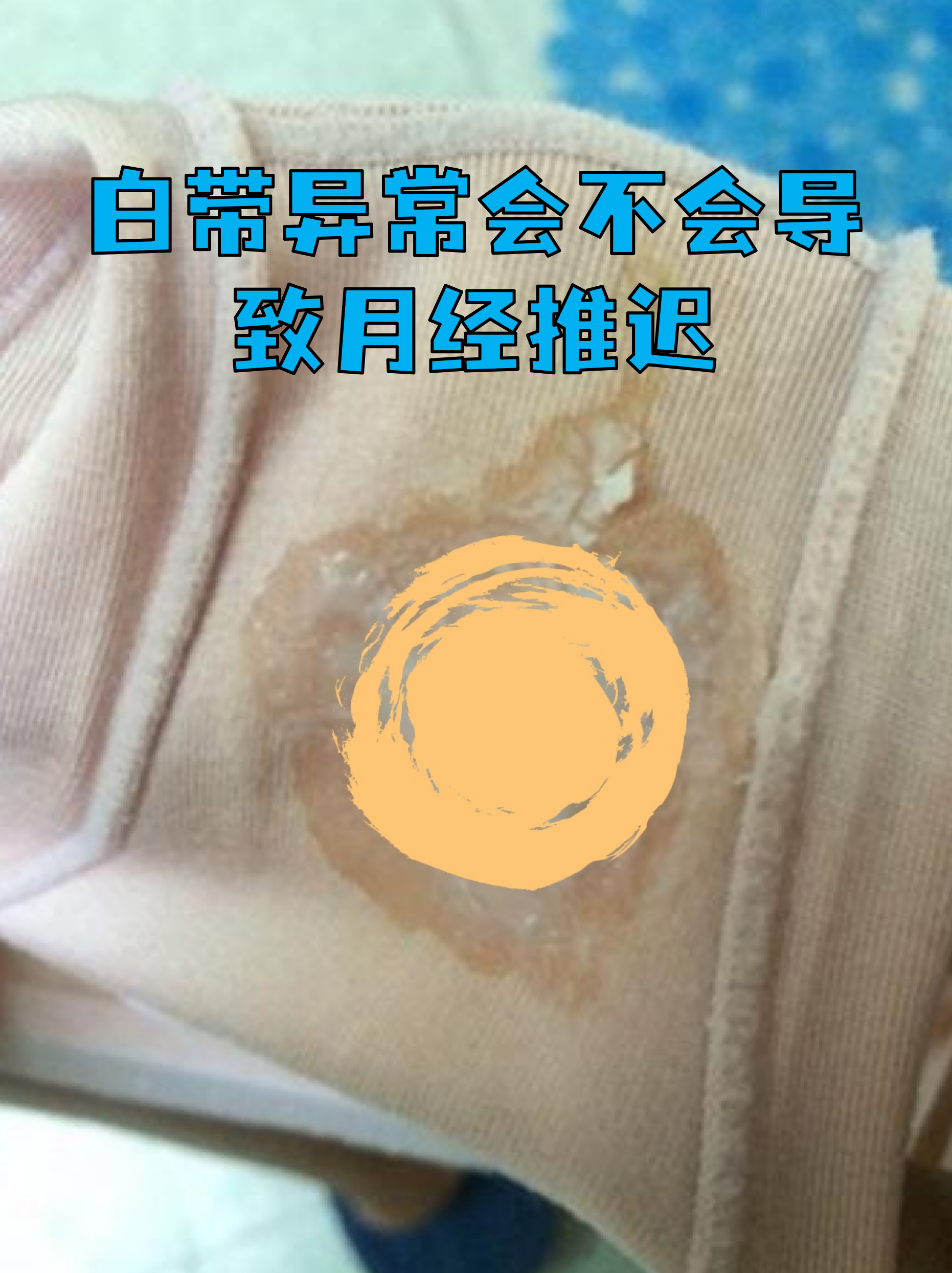 白带异常有几种