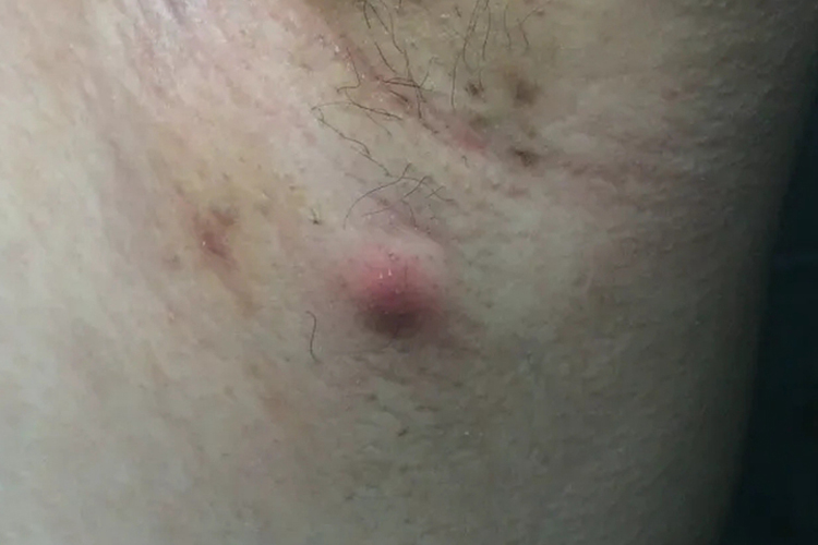 腋窝下有肉疙瘩有点疼是什么病