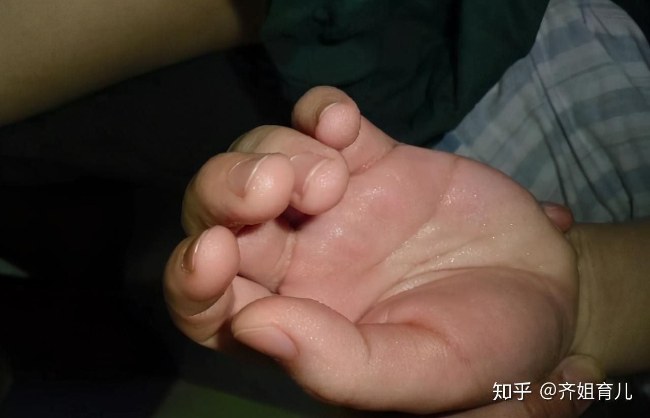 宝宝手心脚心出汗怎么回事?