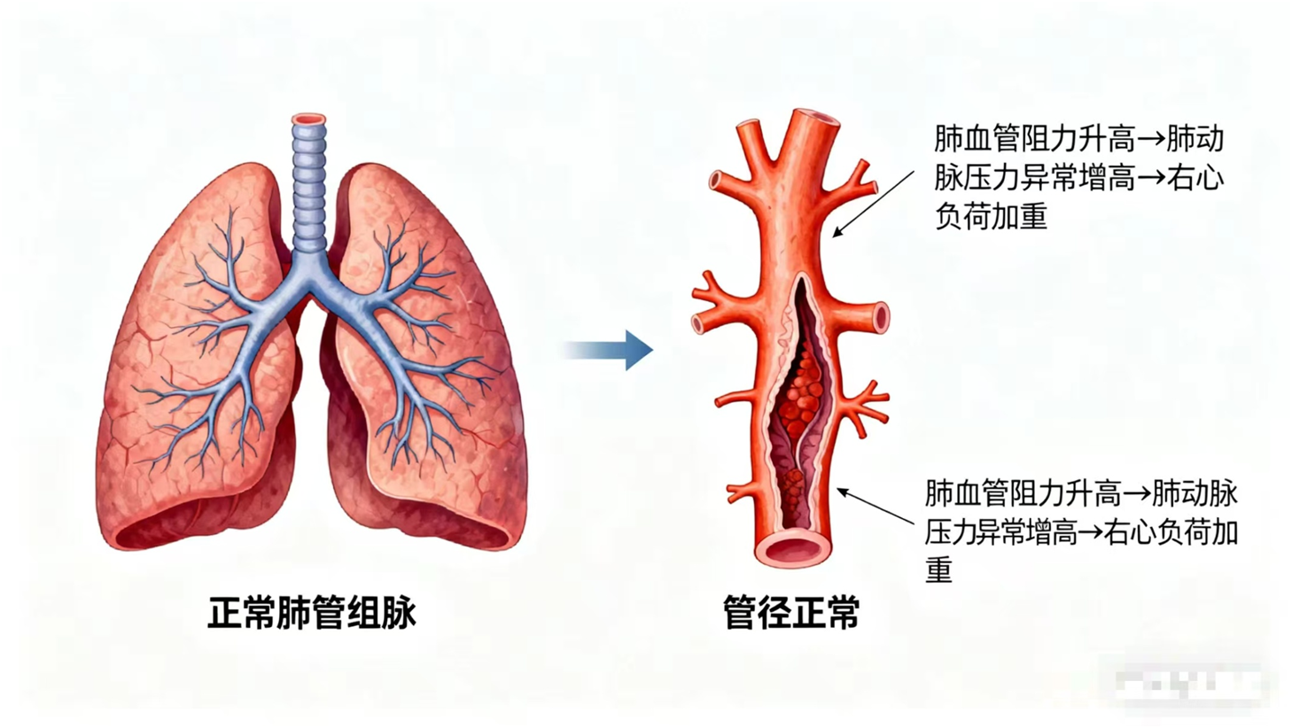 产生肺动脉高压的原因