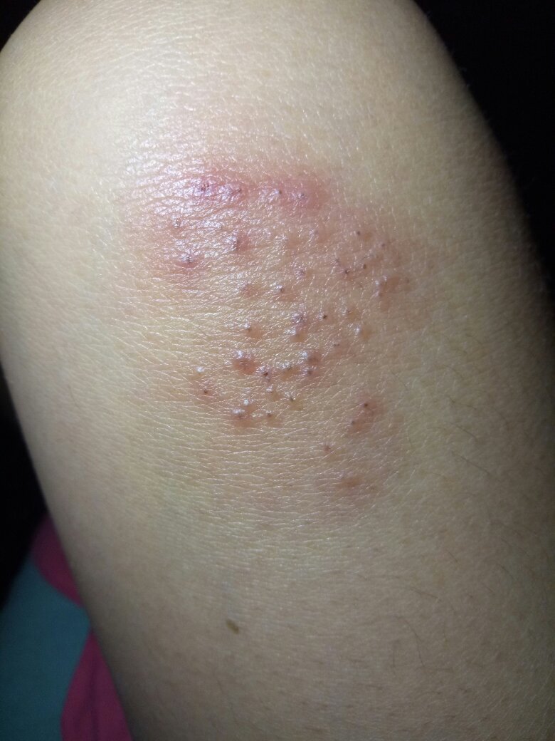 腿部出现红疙瘩但是不痛不痒