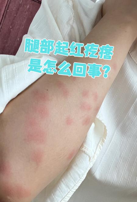 腿部出现红疙瘩但是不痛不痒