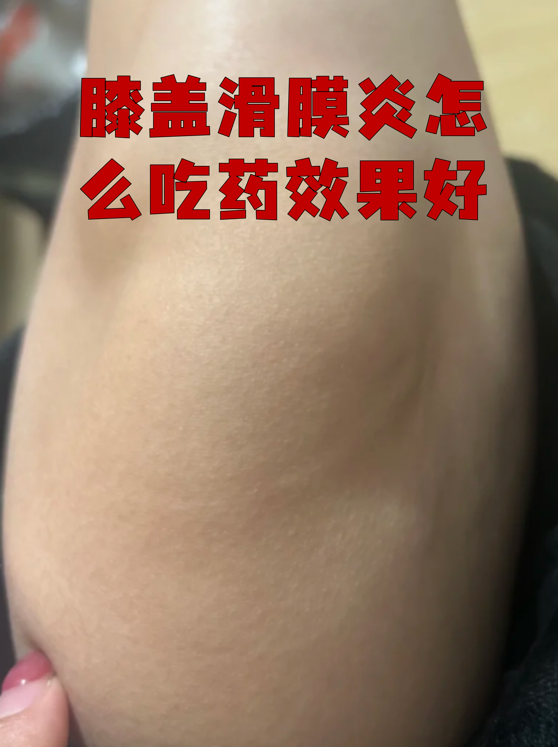 滑膜炎吃什么药效果好?