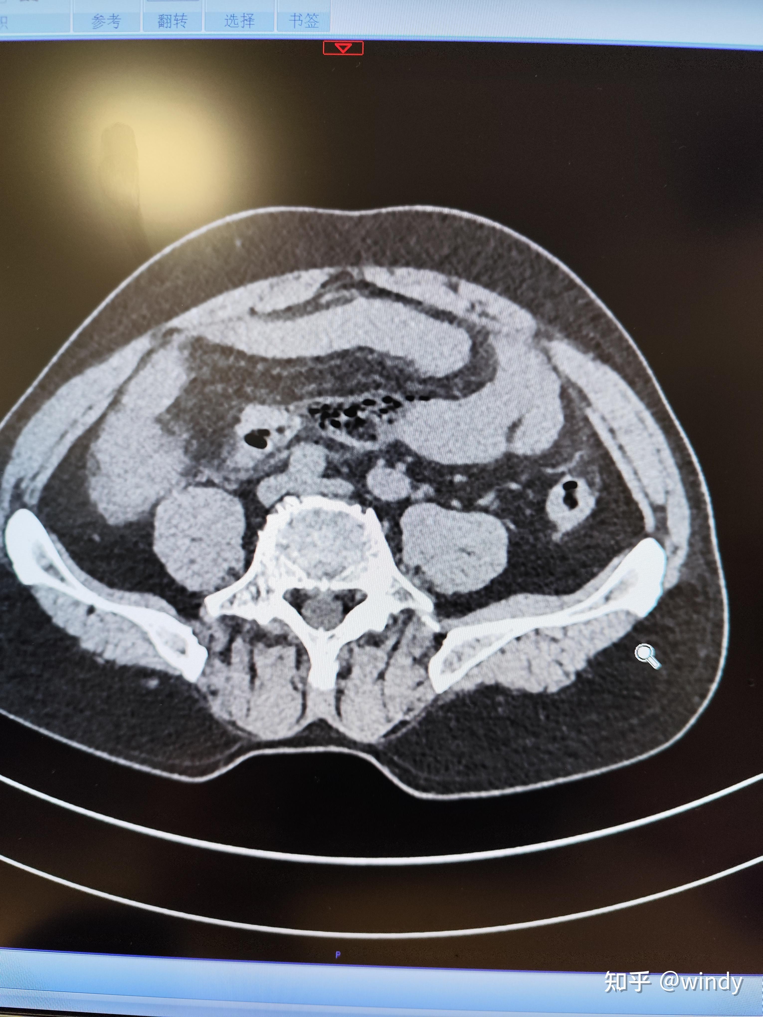 阑尾炎穿孔严重吗