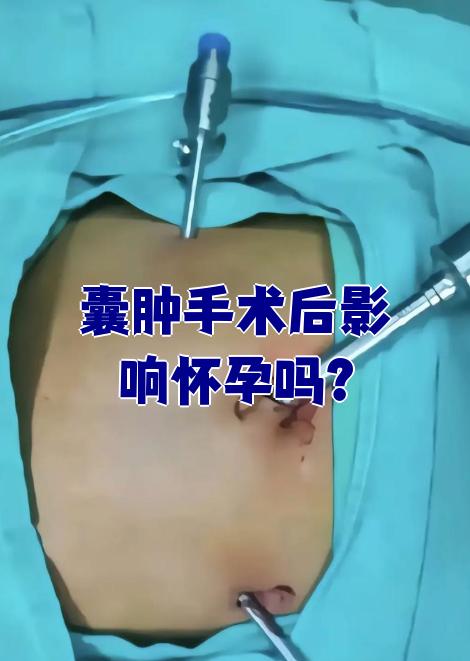 卵巢囊肿一定要做手术吗