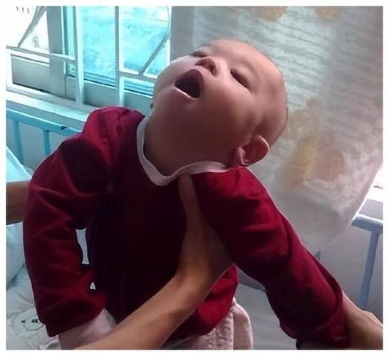 新生儿脑瘫的早期症状