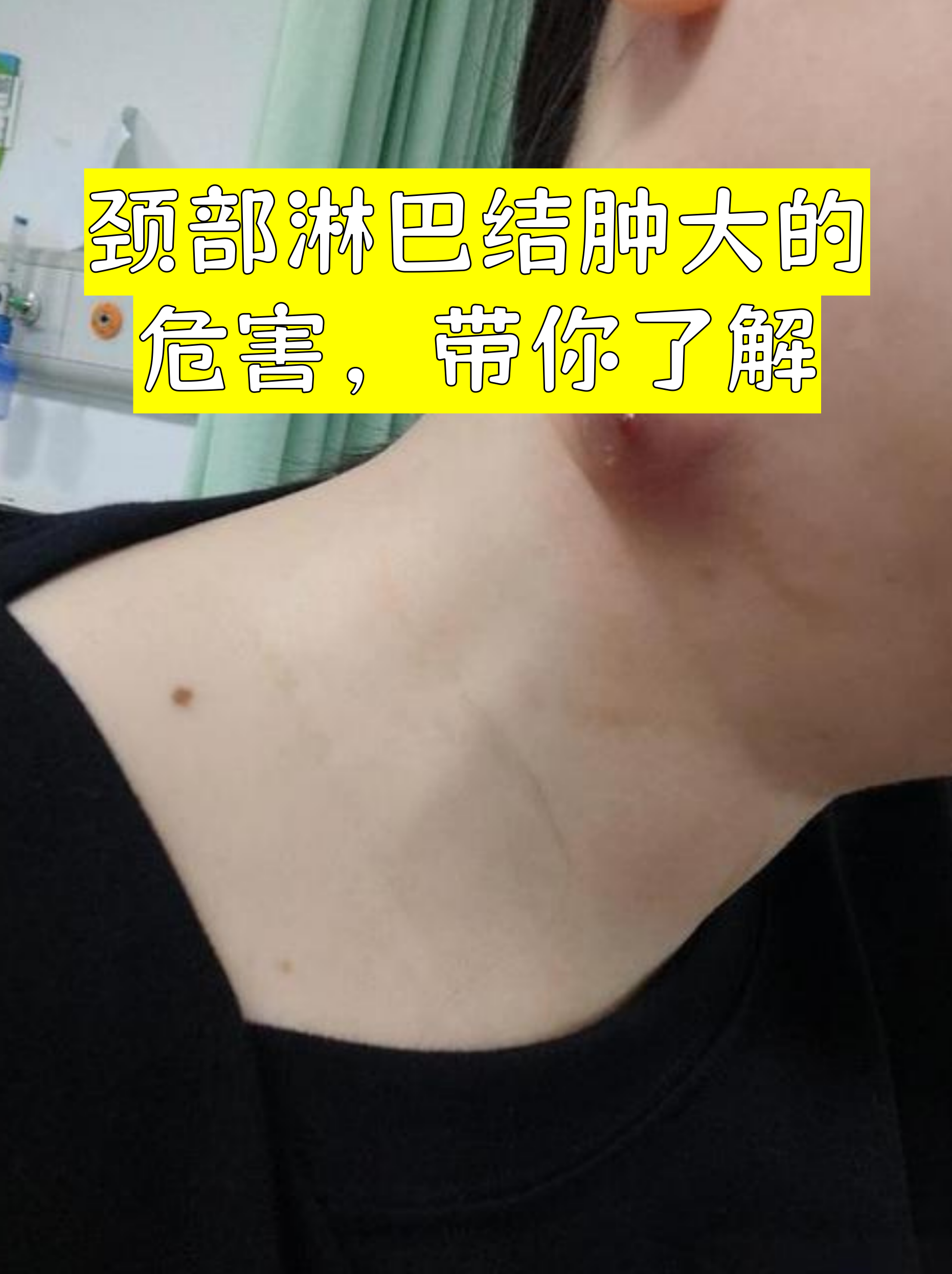 孩子颈部淋巴结肿大怎么办