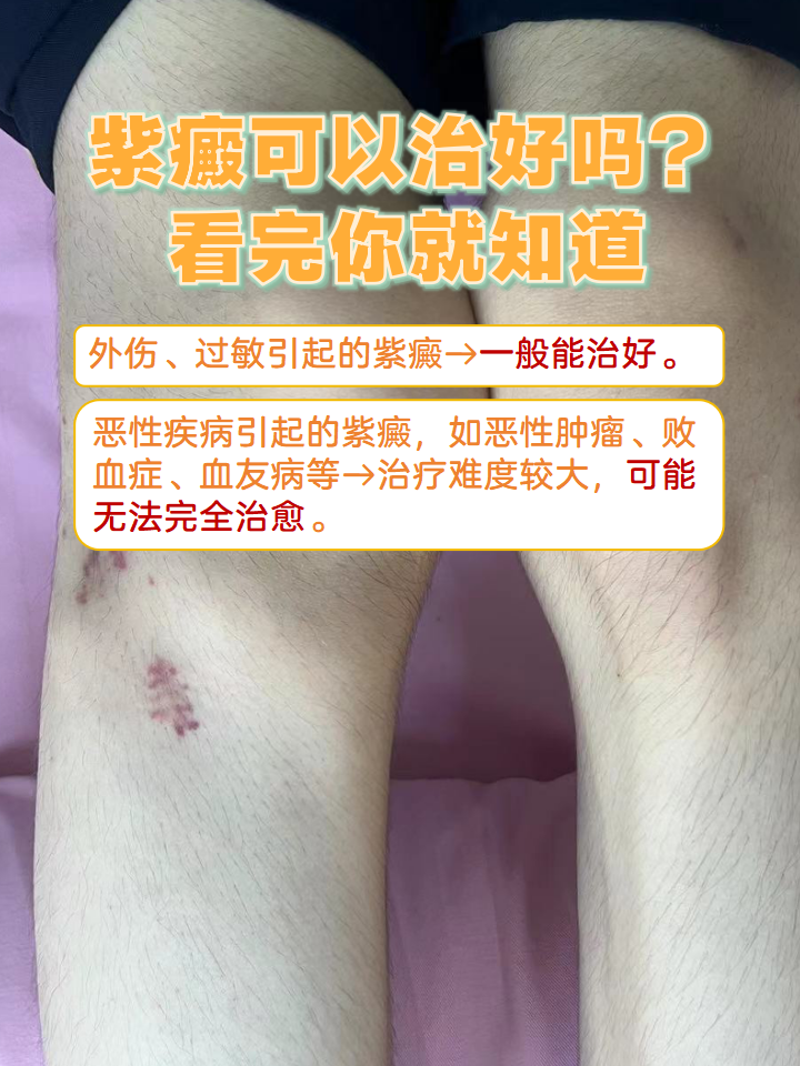 如何判断是不是紫癜?