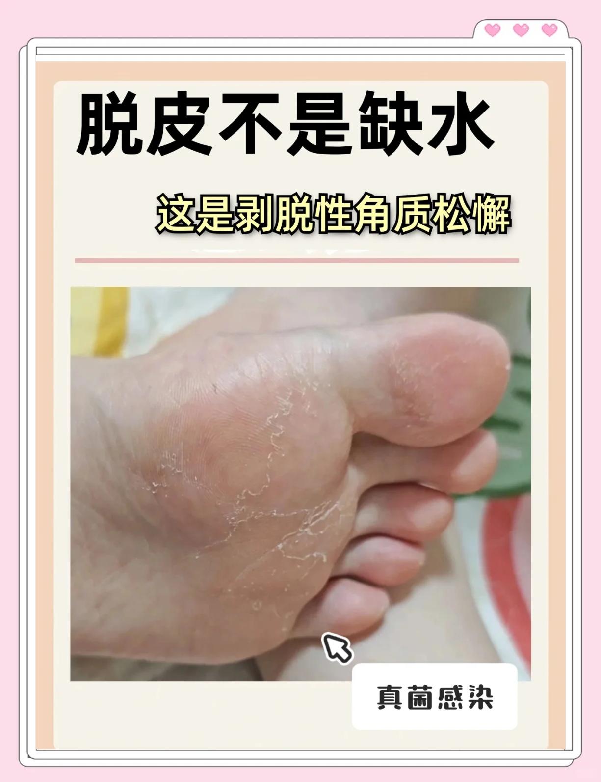 脚手干裂怎么办