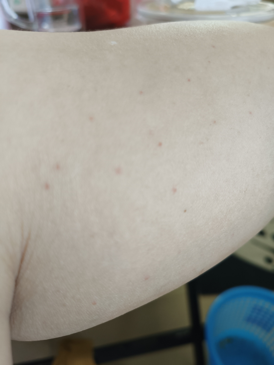 腿上毛孔很多小红点怎么回事