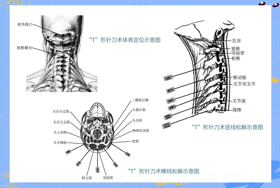 小针刀可以治疗颈椎病吗