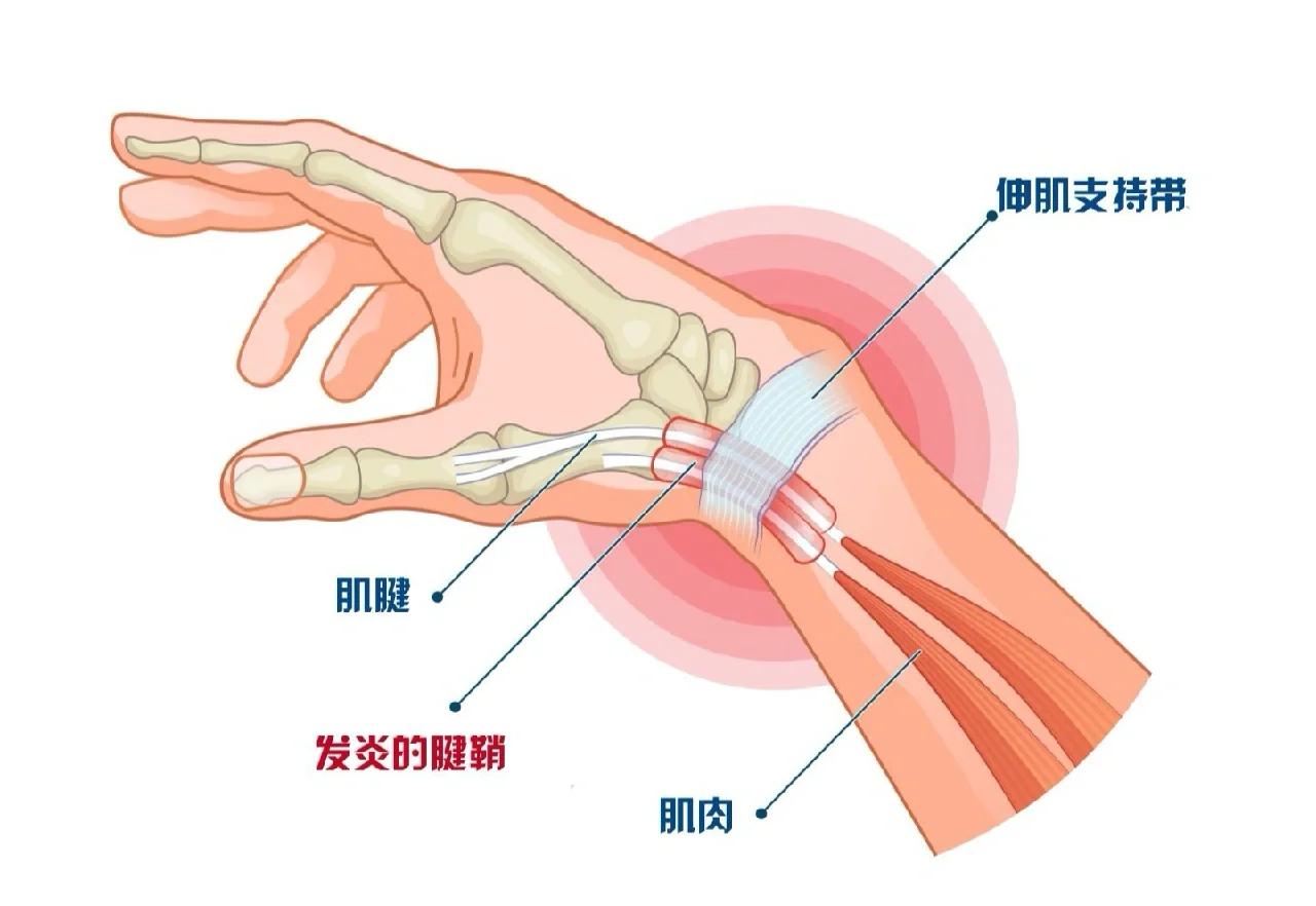 妈妈手怎样治疗?