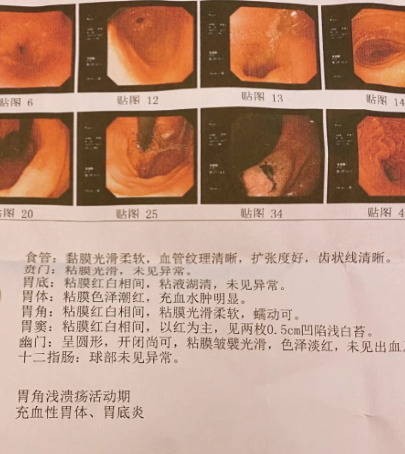 什么叫出血性胃炎?