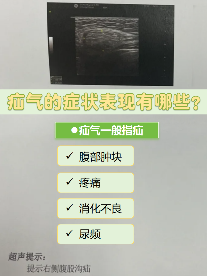 腹股沟疝的早期症状