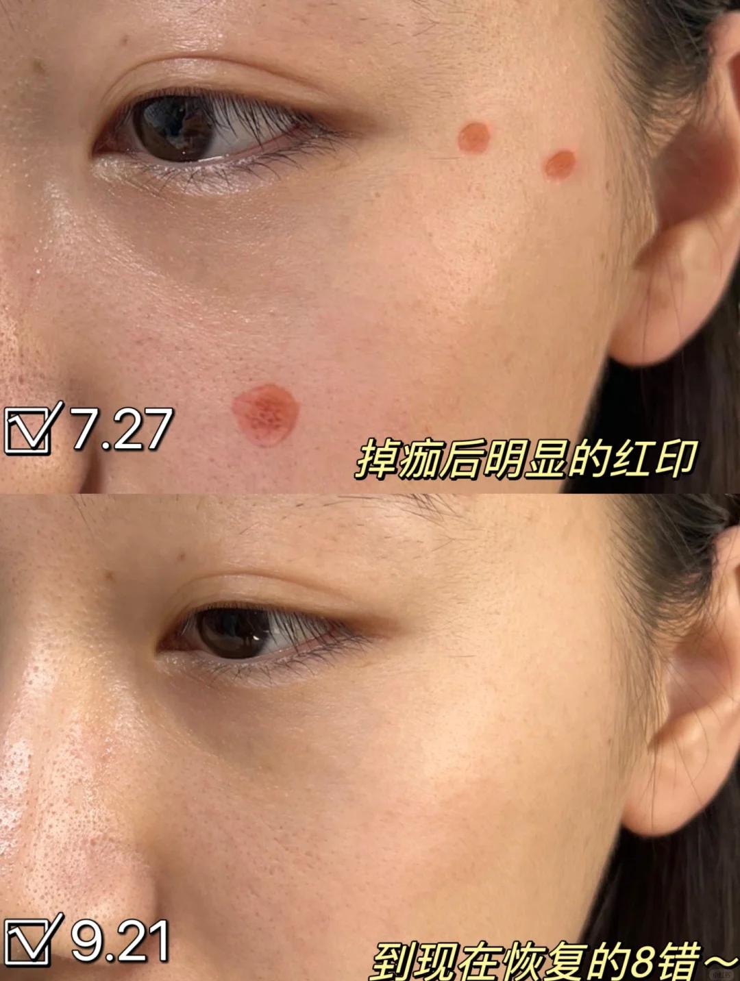 白醋点痣后痣没有掉过了很久那里还是黄的