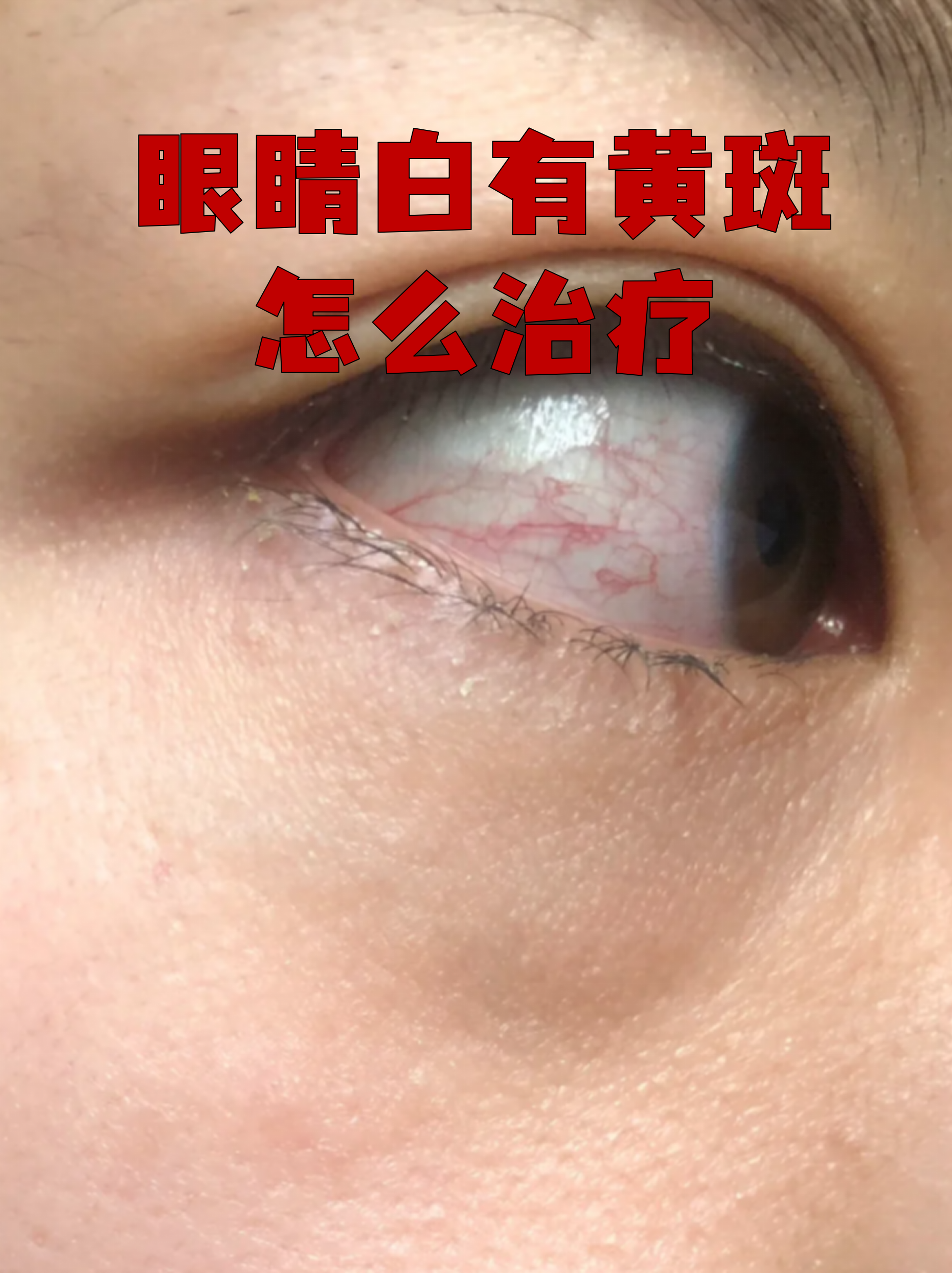 白眼球发黄是怎么回事?