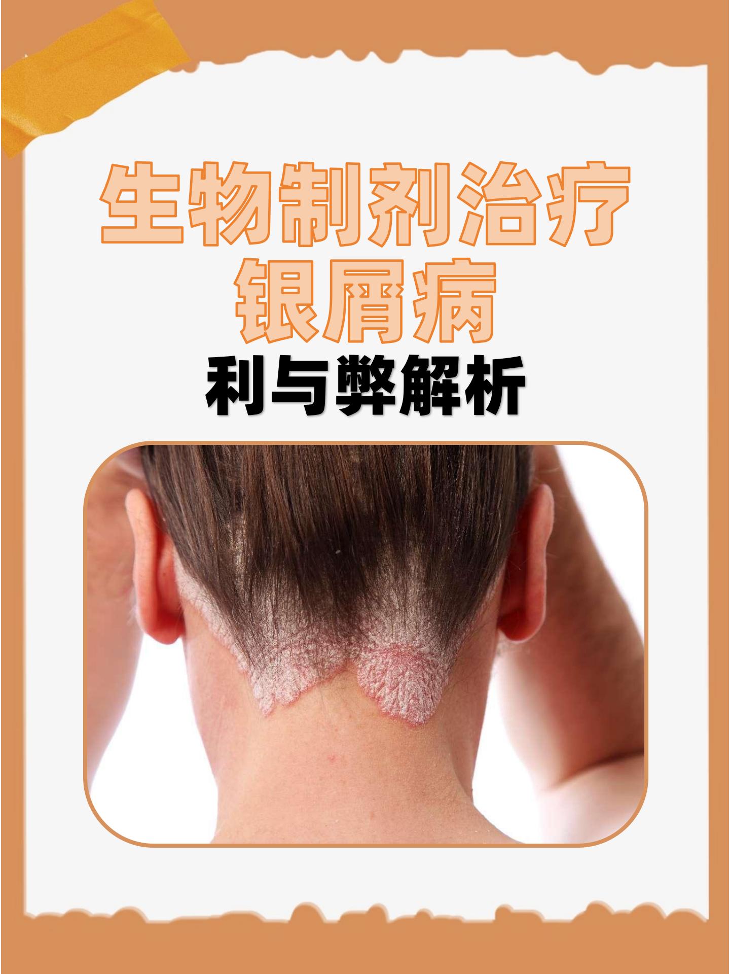 牛皮癣初期如何治疗