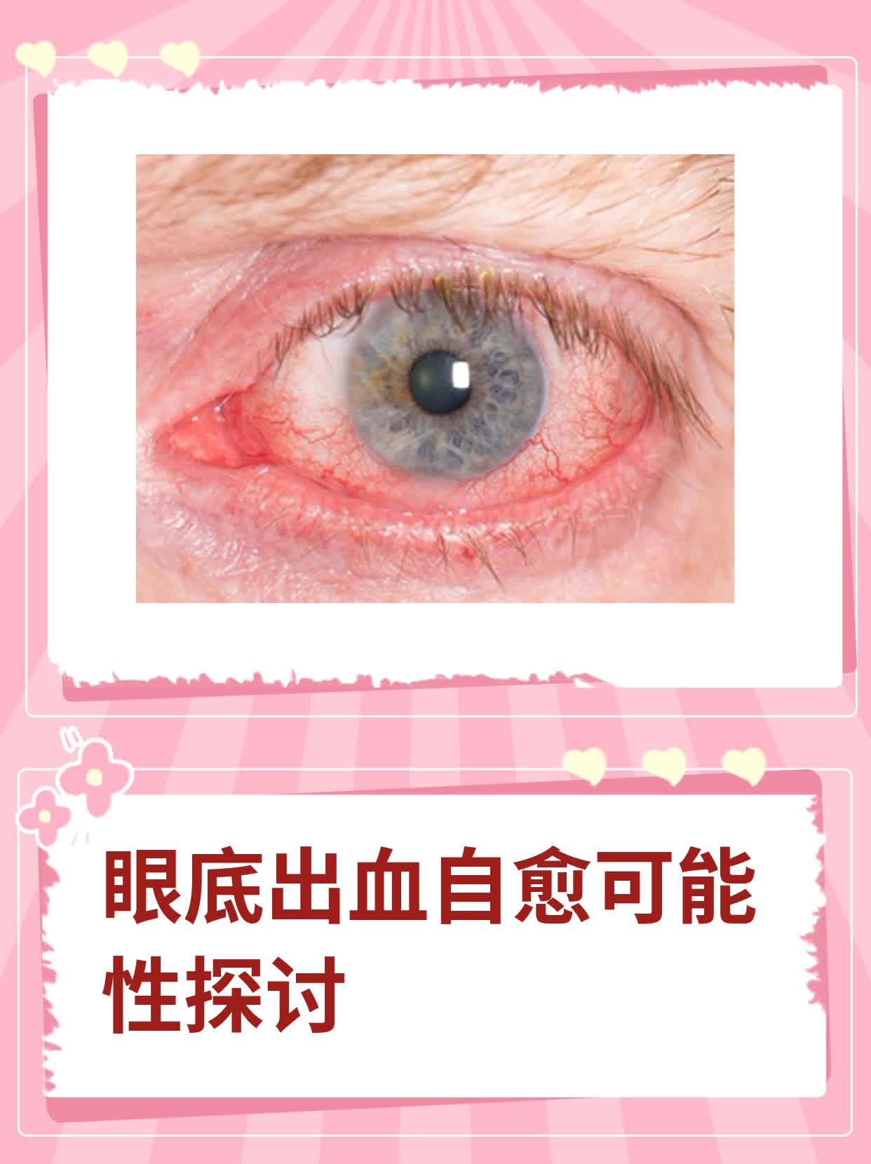 眼底出血是什么原因导致的