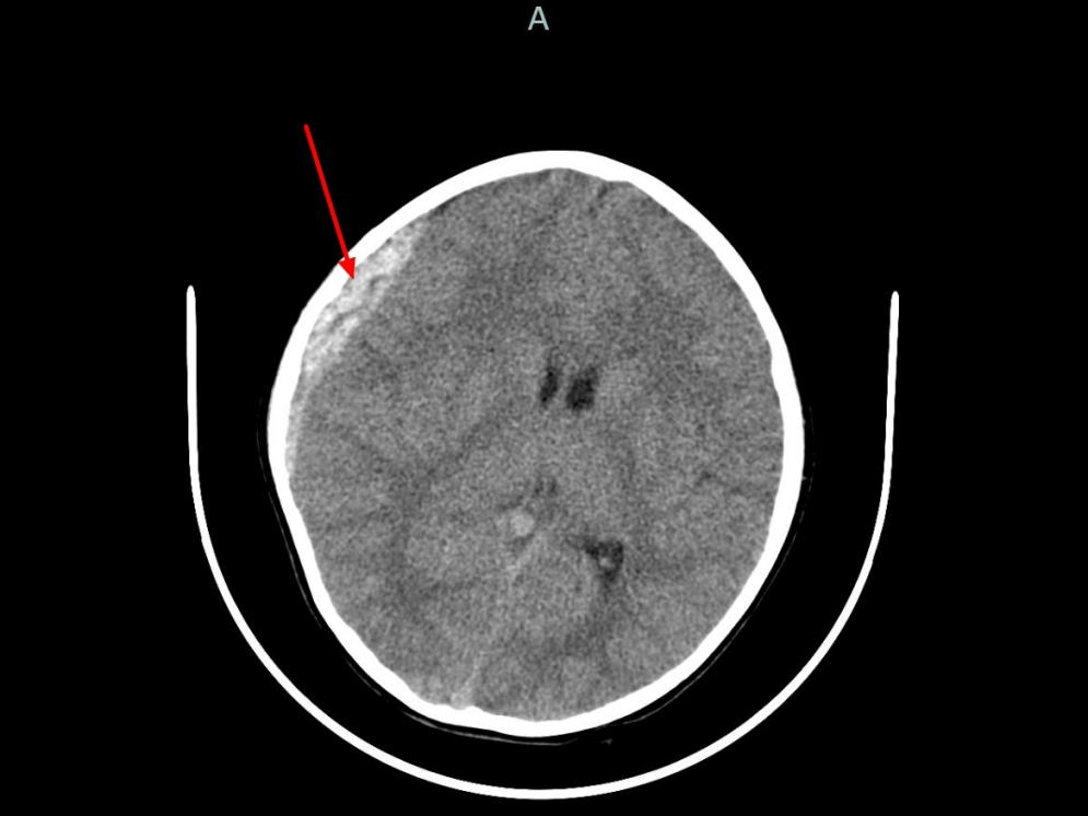颅前窝骨折的临床表现